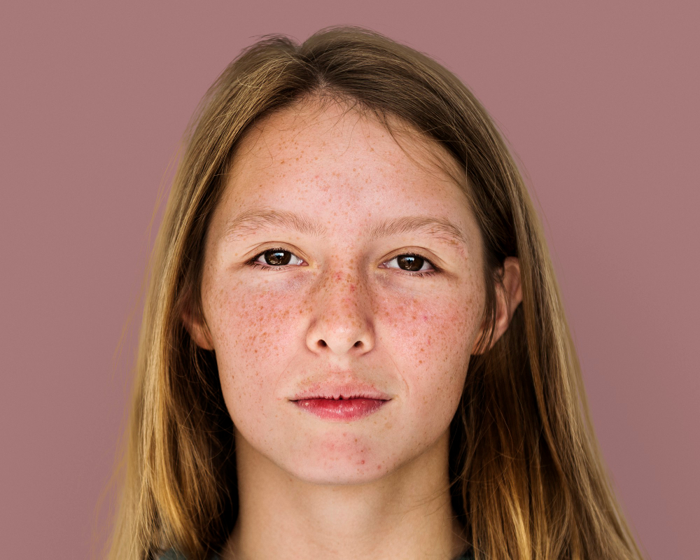 Teen girl with acne-prone skin showing mild breakouts for teen acne skincare article